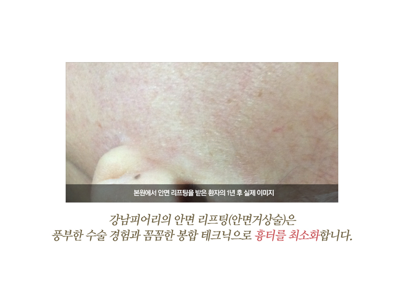 안면거상술 흉터, 최소화할 수 있는 이유-강남피어리 2